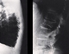 Un rayon X latéral 