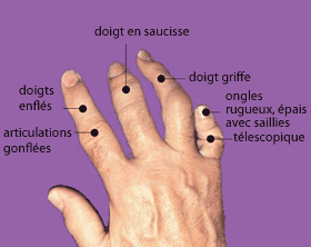 Figure 2 Les doigts ou les orteils peuvent enfler au point de ressembler à des « saucisses ».