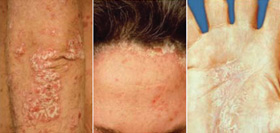 Figure 1 Régions habituellement touchées par le psoriasis.