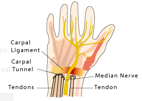 Carpal Tunnel Symndrome occurs when the median nerve is squeezed as it passes through a narrow tunnel of bone and ligament in the palm area of your hand.