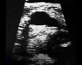Typical appearance of a cyst as seen on an ultrasound image