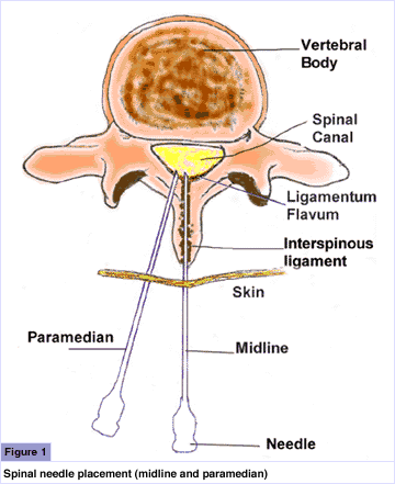 Spinal needle placement (middle and paramedian)