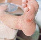 neonatal herpes on foot
