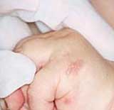 neonatal herpes on hand