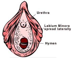 Sites of hypersensitivity and soreness in vestibulitis.