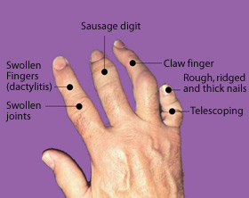 Fingers or toes may become so swollen that they look like sausages.