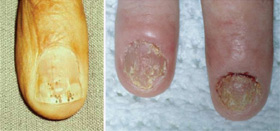Nails may become pitted (small holes), separated from the nail bed, or ridged and cracked.