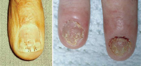 nail bed psoriatic nails arthritis psa figure holes pitted cracked separated ridged become small