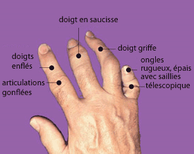 Les doigts ou les orteils peuvent enfler au point de ressembler à des « saucisses ».